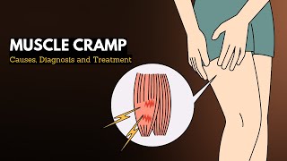 Muscle cramp Causes Signs and Symptoms Diagnosis and Treatment [upl. by Nodnarg182]