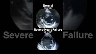 Echocardiogram NORMAL vs SEVERE HEART FAILURE radiology cardiology [upl. by Yemerej]