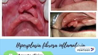 Hiperplasia papilar inflamatoria e hiperplasia fibrosa inflamatoria [upl. by Niels]