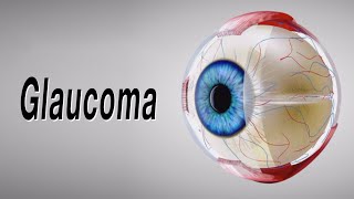 Glaucoma Animation of Why It Happens and How It Can Cause Blindness [upl. by Aneehsor]