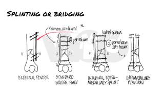 Principles of Fracture Fixation  Orthopedic Basics [upl. by Sira]