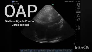 OAP Oedème Aigu du Poumon sur Insuffisance cardiaque gauche chronique Échographie Urgences [upl. by Ashmead319]