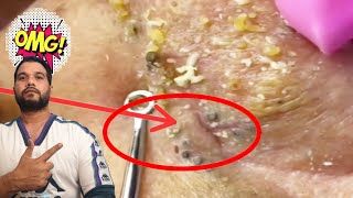 blackhead extraction  nose blackheads removal  nose blackhead [upl. by Herbie255]