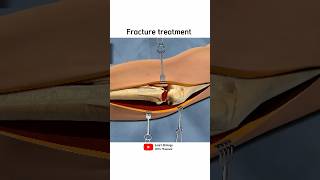 Hand bone fracture treatment  3D animation [upl. by Eicyal]