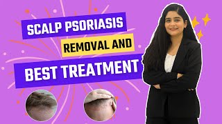 What Is Scalp Psoriasis   Scalp Psoriasis Removal and Best Treatment  Dr Megha Chaturvedi [upl. by Notsehc]