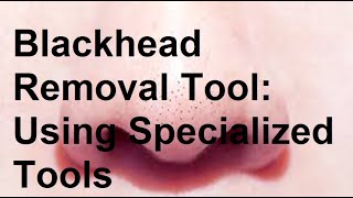 Blackhead Removal Tool Using Specialized Tools Like a Comedone Extractor [upl. by Solakcin]