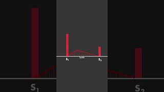 Aortic Stenosis [upl. by Akiem]