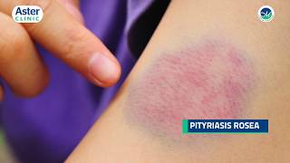 Dr Srinivasa Munivenkatappa talks about Pityriasis Rosea [upl. by Leirol860]