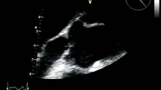 BIG AORTIC VEGETATION  INFECTIVE ENDOCARDITIS ECHOCARDIOGRAPHY cardiac ultrasound [upl. by Attehcnoc681]