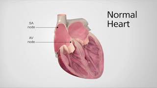 Normal Heart vs Heart in AFib [upl. by Giles]