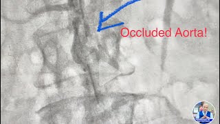 Occluded Aorta infrarenal CTO Revascularization of Aorta and Iliac artery  Lithotripsy amp stent [upl. by Oppen]