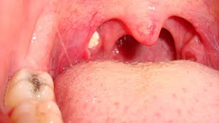 How to Get Rid of Tonsil Stones  Home Remedies [upl. by Daryn]