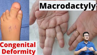 Macrodactyly Treatment  How to Treat Macrodactyly  Congenital Deformity [upl. by Eladnor372]