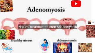 Natural treatment of Adenomyosis in the English languageadenomyosis [upl. by Cuthburt]