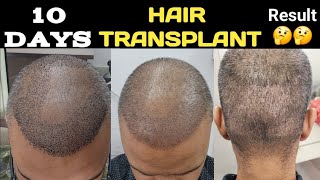 My 10 days hair transplant result Donor area condition swelling [upl. by Novhaj]