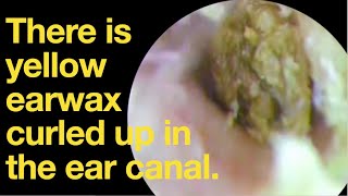 There is yellow earwax curled up in the ear canalear wax removal  ear cleaning  ASMR  relax [upl. by Dalt692]