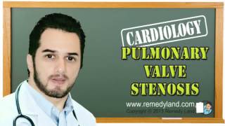 Pulmonary valve stenosis  clinical picture symptoms and signs ECG treatment Prognosis [upl. by Hildy]