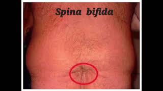 Spina bifida mrcpch Clinical Neurology [upl. by Ahsemac]