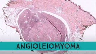 Angioleiomyoma leiomyoma vascular type painful skin bump often on leg [upl. by Aymahs]