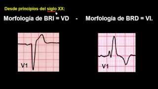 CURSO DE ELECTROCARDIOGRAFIA 48  EXTRASÍSTOLES VENTRICULARES [upl. by Lavona]