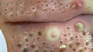 Big Cystic Acne Blackheads Extraction Blackheads amp Milia Whiteheads Removal Pimple Popping  703 [upl. by Ridgley]