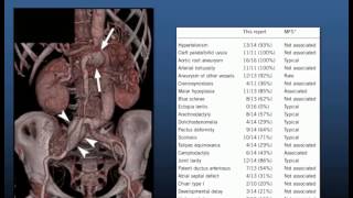 Prof Richmond Jeremy Familial aortic diseases [upl. by Amaj]