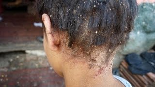 Dealing with Lice 3 Home Remedies That Actually Work Shorts [upl. by Nowahs]