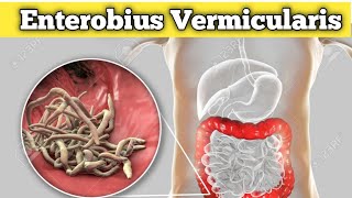 Enterobius vermicularis Habitat life cycle and pathogenicity etc [upl. by Ignace]