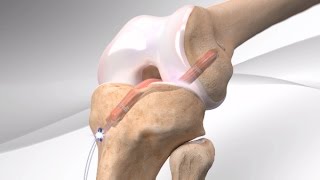 AllInside ACL Reconstruction with Arthrex® GraftLink® [upl. by Eckhardt690]