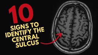 How to find the central sulcus on MRI [upl. by Adiaj]