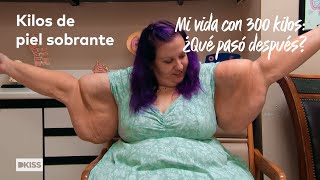 La realidad de tener kilos de piel sobrante  Mi vida con 300 kilos ¿Qué pasó después [upl. by Lita]