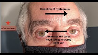 What ear does the nystagmus in vestibular neuritis beat towards [upl. by Annahc]