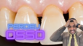 PERDA ÓSSEA NA BOCA E AO REDOR DOS DENTES [upl. by Eniamaj907]