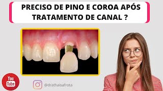 Tratamento de canal preciso colocar pino e coroa no dente [upl. by Mclaughlin]