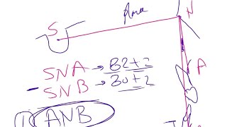 02 utilization of SN plane Cephalometric analysis [upl. by Ellimac632]