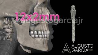 Guia dos miniimplantes  orthodontic TADs guide [upl. by Ettenaej]