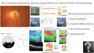 Lecture Using OCT as an Approach to Diagnose Glaucomatous and Other Optic Neuropathies [upl. by Yessydo354]