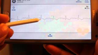 AliveCor Mobile ECGEKG accuracy test review [upl. by Kcerred]