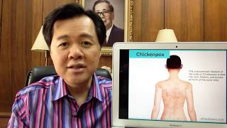 Chicken Pox o Bulutong Tubig  Payo ni Dr Willie Ong 100 [upl. by Gleich821]