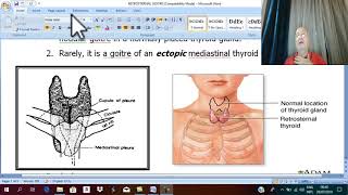 Thyroid Disorders in English 9 Retrosternal Goiter   by Dr wahdan [upl. by Magner1]