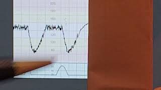 CTG interpretation  Cardiotocography  Dr Abdulrahim Gari [upl. by Llennahs]