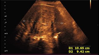 Sonographic prediction of a large intramural fibroid [upl. by Izy]