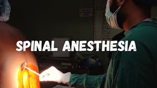 How to give spinal anesthesia  LEARN IN 1 MINUTE [upl. by Milli]