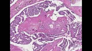 Histopathology BreastDuctal carcinoma in situ [upl. by Dorette]