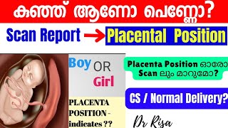 Gender Prediction Malayalam Anterior Placental Boy Girl കുഞ്ഞ് ആണോ പെണ്ണോ [upl. by Toscano677]