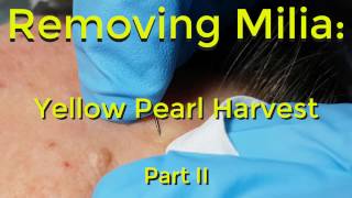 Removing Milia Yellow Pearl Harvest  Part II [upl. by Hafital]