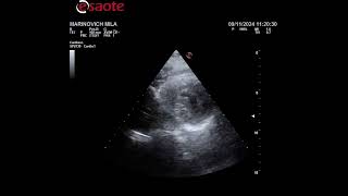 paraesternal medioventricular [upl. by Sundstrom]