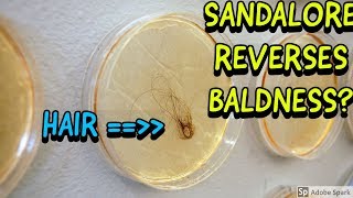 SANDALORE REVERSES HAIR LOSS [upl. by Auberta]