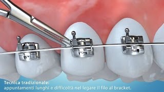 Video Animazione 3D tecnica di allineamento dentale con bracket [upl. by Dareg]