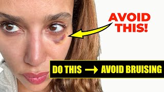 How to Prevent Bruising from Botox and Filler DO THIS Before you get Facial Injections [upl. by Ellahcim]